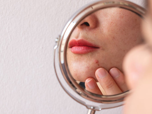 5 Reasons Why Your Skin is Breaking Out
